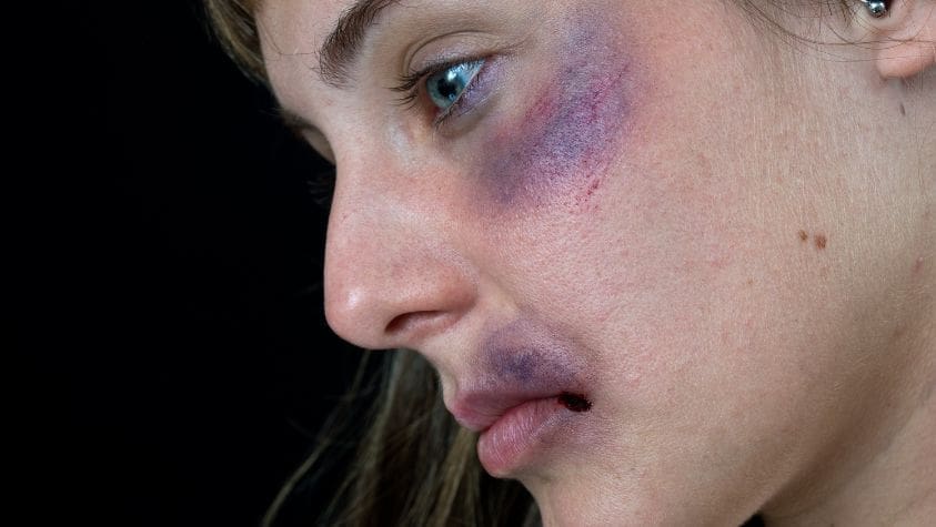 Girl with bruises on her face.